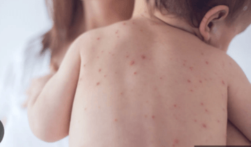 Chicken Pox