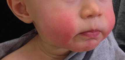 Slapped Cheek