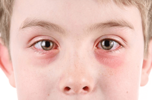 Conjunctivitis