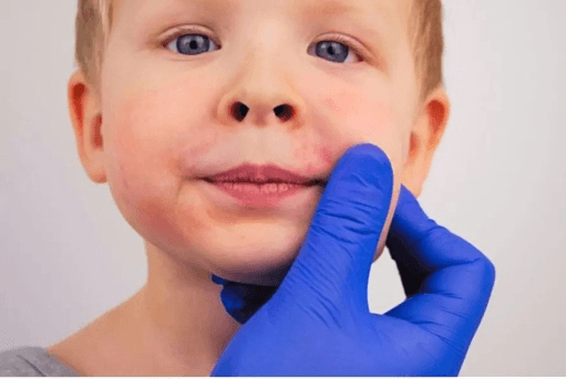 Impetigo