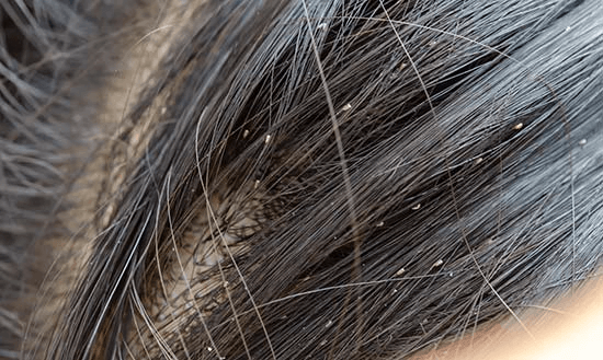 Head Lice